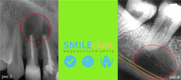 развитие кисты фото2