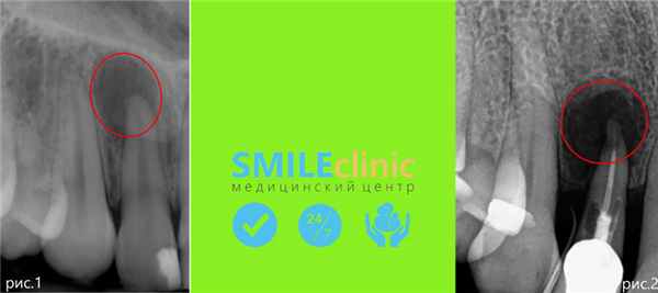 развитие кисты фото1