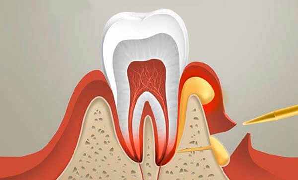 абсцесс зуба