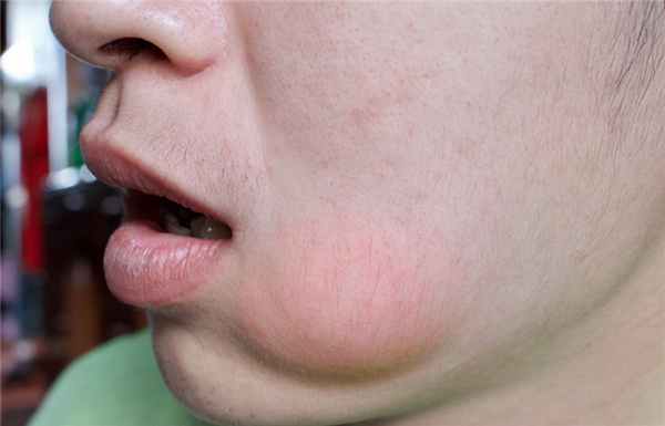 Абсцесс зуба 2