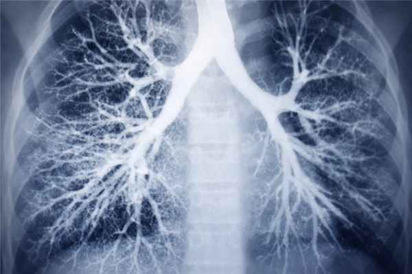 Бронхоэктатическая болезнь