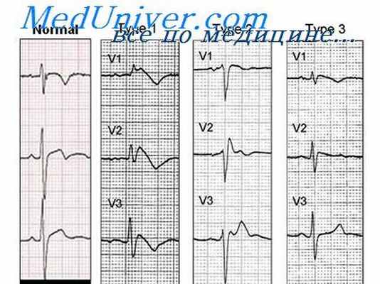 кардиомиопатии экг