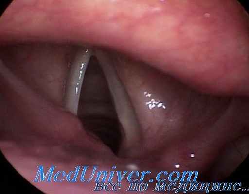 паралич гортани и голосовых складок