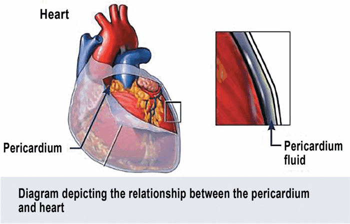 Строение перикарда и место накопления перикардиальной жидкости(http://www.cvcavets.com/images/pericardial.jpg).