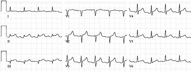 Электрокардиограмма при перикардите