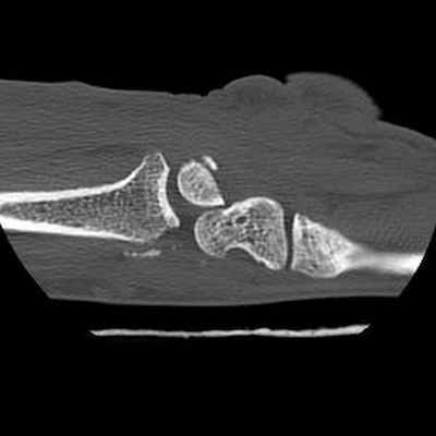 Трансладьевидно-перилунарный вывих запястья III-его типа Sagittal