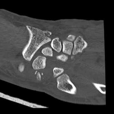 Трансладьевидно-перилунарный вывих запястья III-его типа Coronal