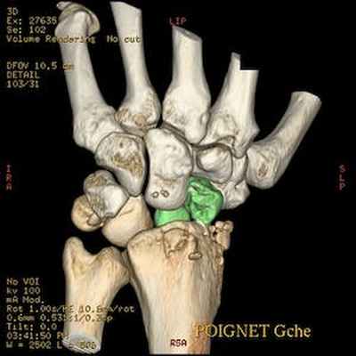 Трансладьевидно-перилунарный вывих запястья III-его типа 3D
