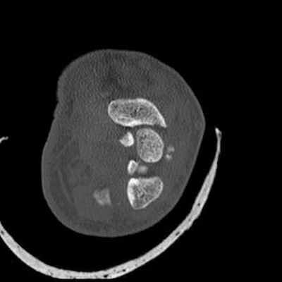 Трансладьевидно-перилунарный вывих запястья III-его типа Axial
