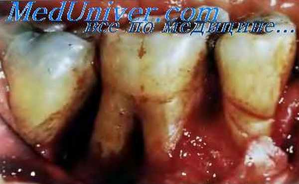 Периодонтит