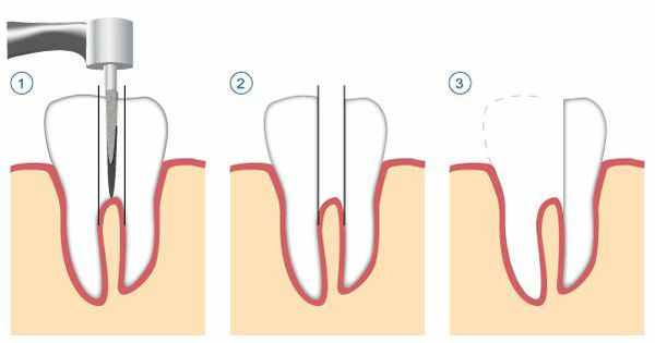 Удаление корня целиком