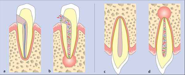 Медикаментозный периодонтит