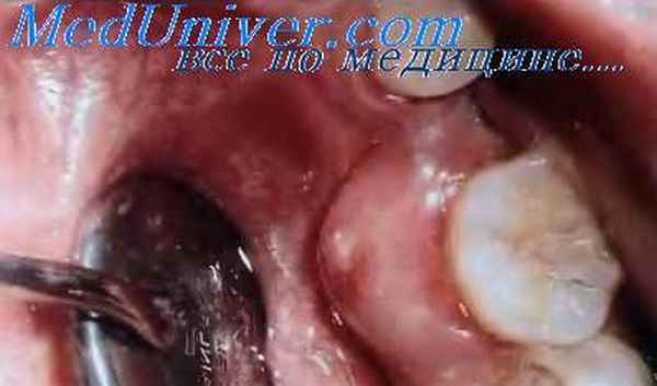 Периодонтальный абсцесс