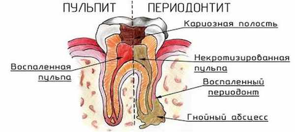 Периодонтит причины