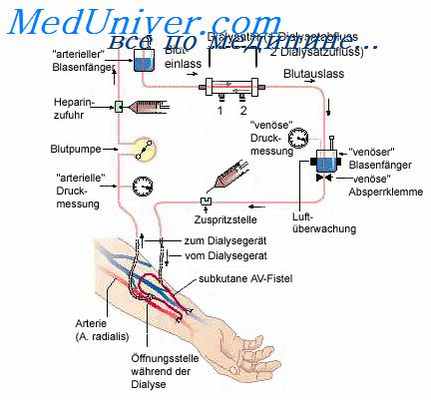 перитонеальный диализ