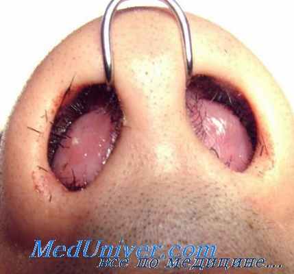 язва носовой перегородки