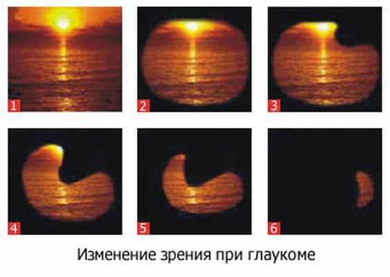 glaukoma.jpg