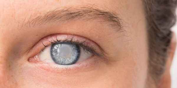 Ювенильная (юношеская) глаукома