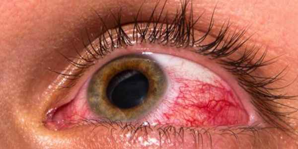 Вторичная глаукома