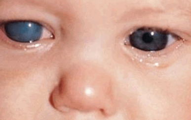 Врожденная глаукома