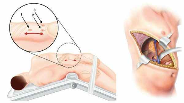 Эндоскопическая и открытая адреналэктомия