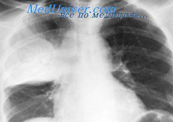 первичный туберкулез