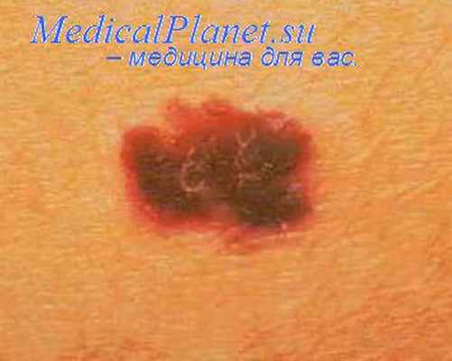 диспластический невус