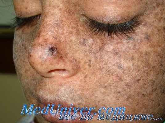 Пигментная ксеродерма