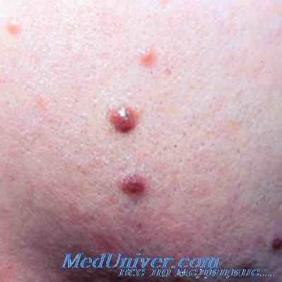 ксеродерма