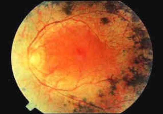 Пигментный ретинит