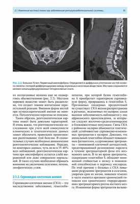 Рис. 2.2. Больная 70 лет. Первичный миелофиброз.