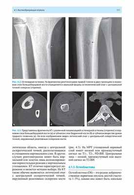 Рис. 4.3. Представлены фрагменты КТ с различной локализацией остеоидной остеомы