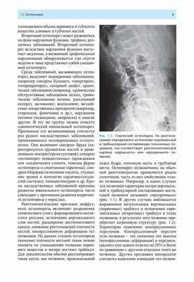 Рис. 1.1. Старческий остеопороз.