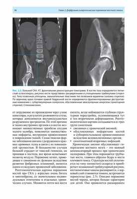 Рис. 2.3. Больной СКА. КТ, фронтальная реконструкция томограмм.