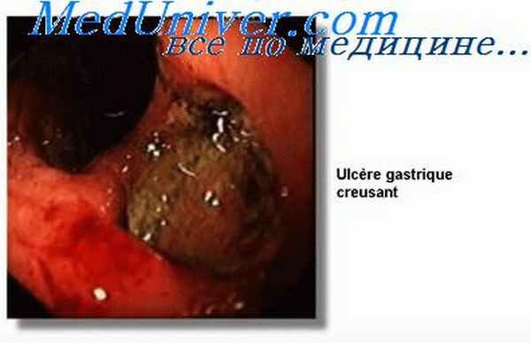 пилородуоденальный стеноз