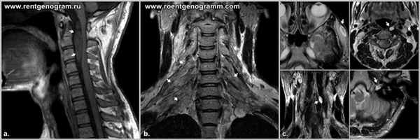 neyrofibromatoz-I-tipa-mrt-pozvonochnik