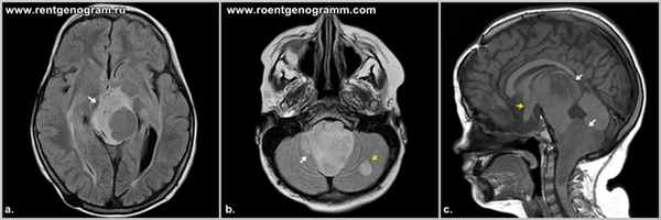 neyrofibromatoz-I-tipa-mrt
