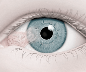 Памятка пациенту. Удаление птеригиума. 