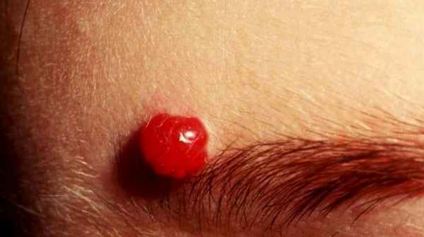 Пиогенная гранулема