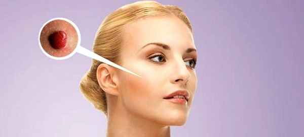 гранулема симптомы