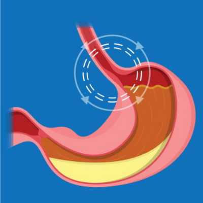 Пищевод Барретта