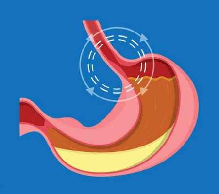 пищевод барретта