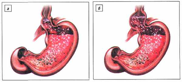 Кислотный карман у больных с: а) небольшой ГПОД; б) ГПОД больших размеров (Янова О.А.)