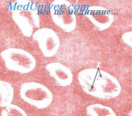 плазмаферез