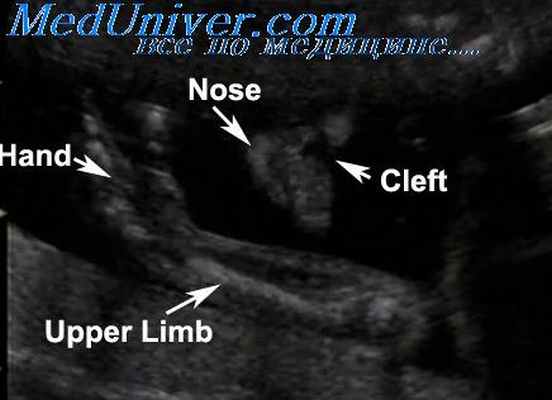 плевральный выпот плода