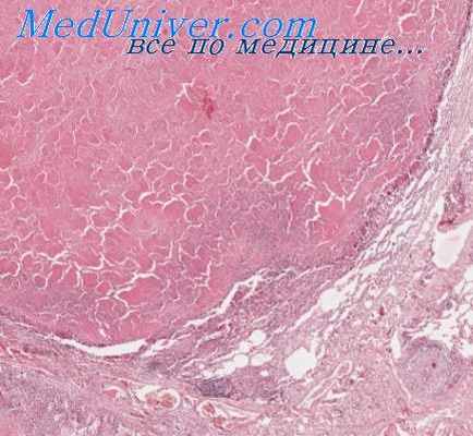 плевризация культи бронха