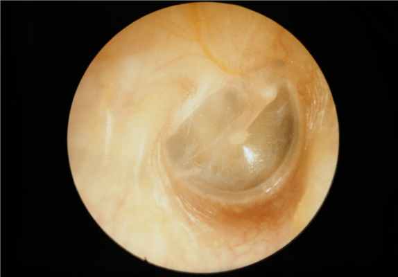 Острый средний отит