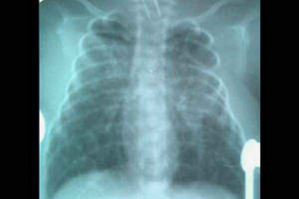 Пневмомедиастинум