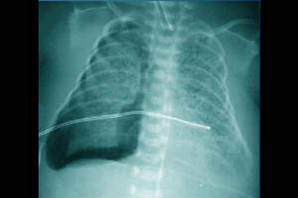 Интерстициальная легочная эмфизема