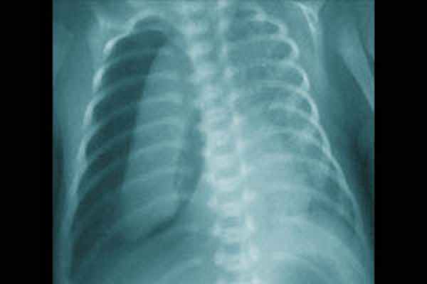 Пневмоторакс